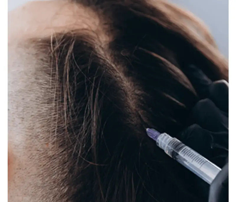 mesotherapy in istanbul
