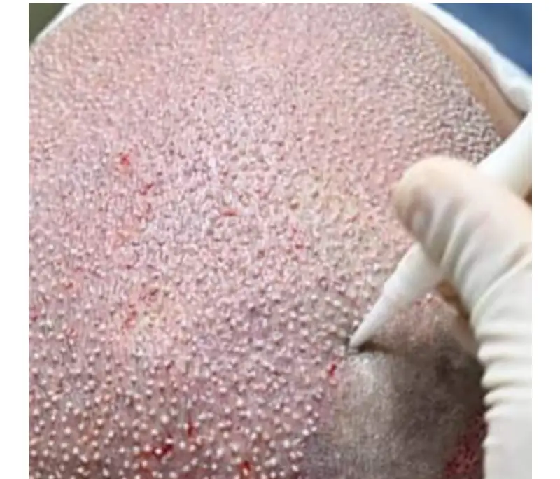 Hair Transplant in Istanbul