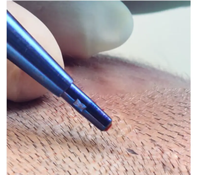 Hair Transplant in Istanbul