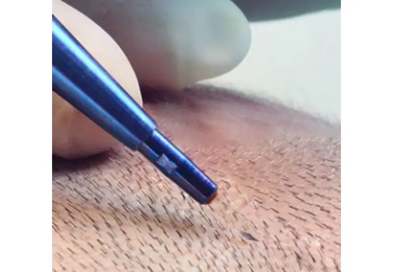 hair transplant in Istanbul