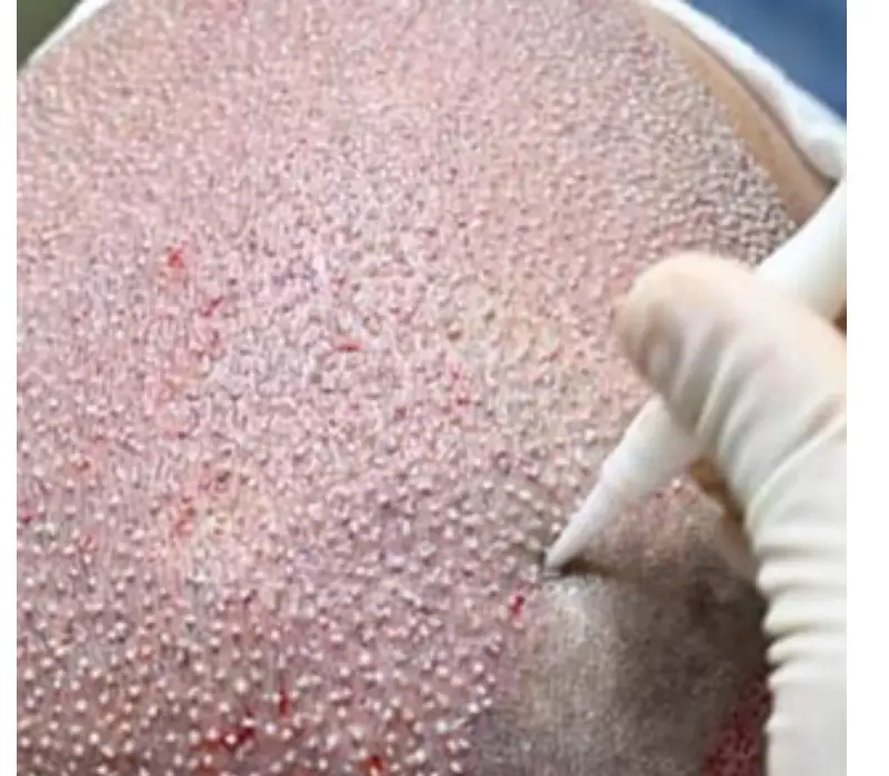 hair transplant in Turkey