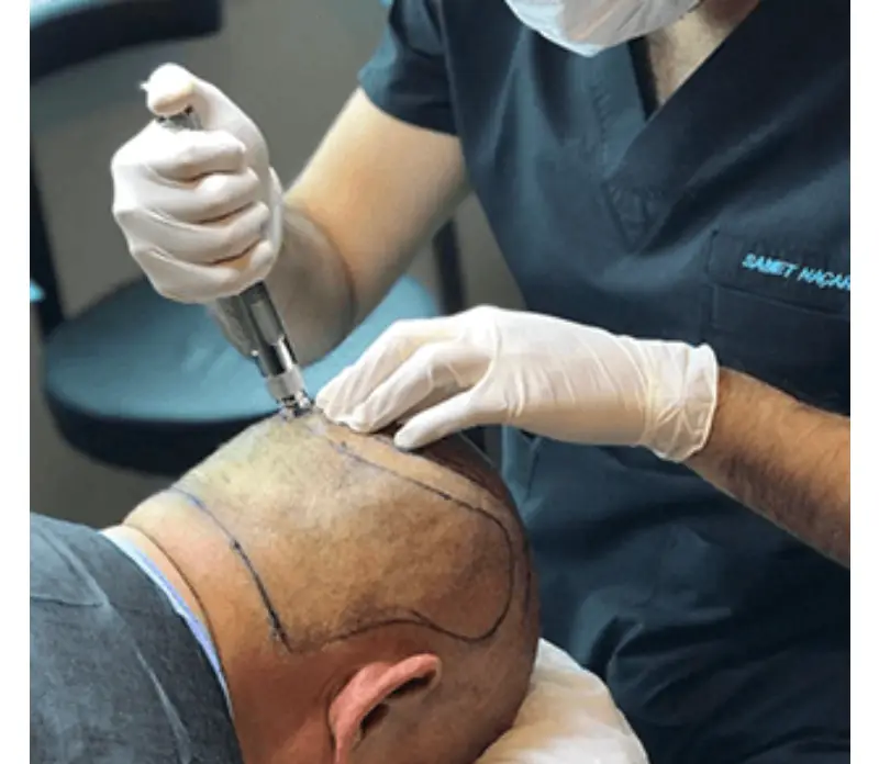 hair transplant in Turkey